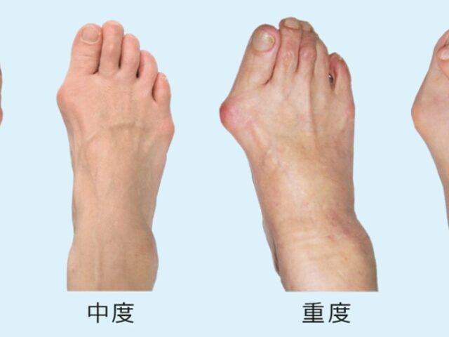 外反母趾 「朝一歩目が痛い…それ足のトラブルかも？」