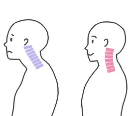 最近増えているストレートネックとは？首のカーブの乱れが頭痛や肩こりを引き起こす理由